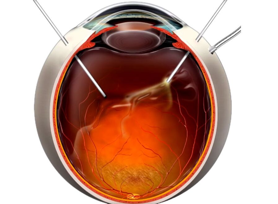 Vitrectomia un processo che è mostrato nella peeling della retina
